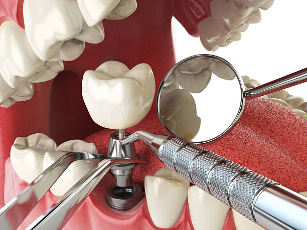 Best Urgent Care for Lost Fillings or Crowns in Blandon, PA